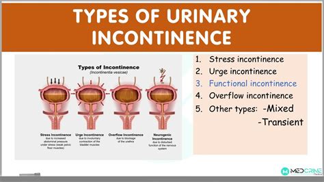 4 types of urinary incontinence.